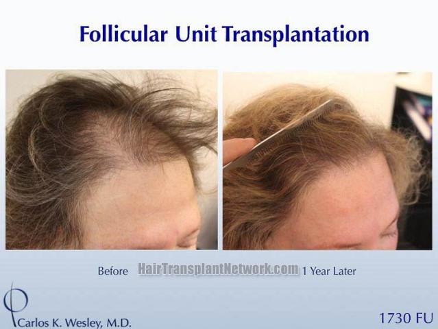 Female hair transplantation procedure before and after results