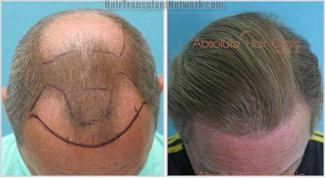 Hair transplantation procedure before and after photos