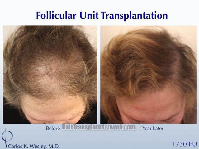 Female before and after hair transplant procedure images