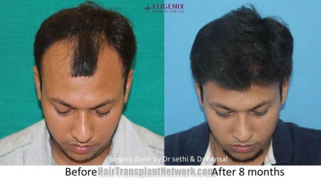 Before and after FUE hair restoration procedure images
