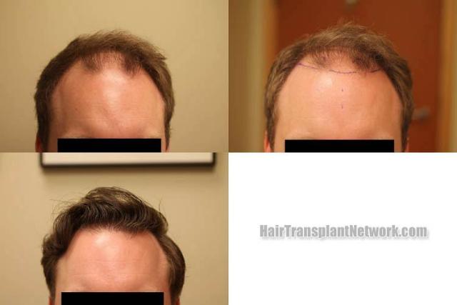 Front view - Before and after transplantation surgery