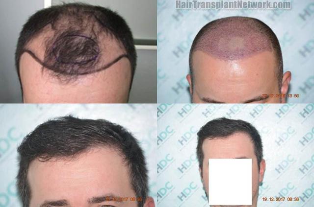 Before and after hair restoration procedure images