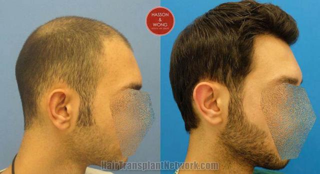 Hair transplantation surgery before and after images,