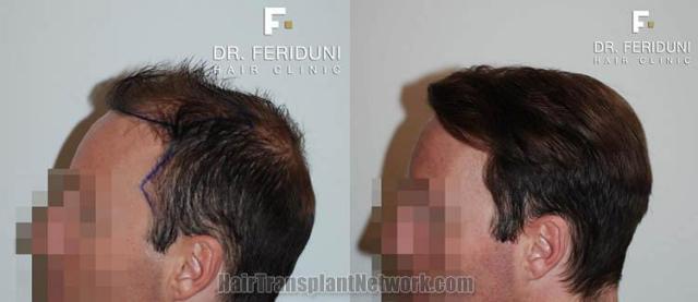 Hair transplantation surgical procedure before and after images
