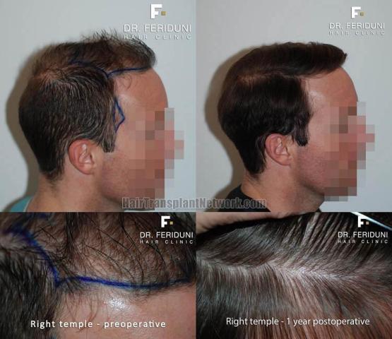 Hair transplantation procedure before and after photos