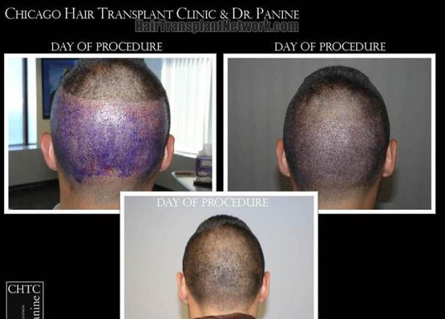 Hair transplantation procedure before and after photographs
