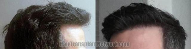 Hair transplantation surgery after images