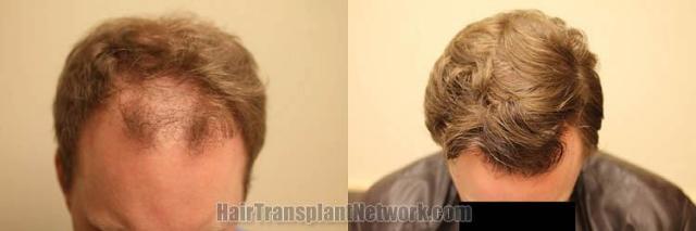 Hair restoration procedure before and after result photos