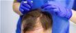 Ultimate Guide To Hair Transplants