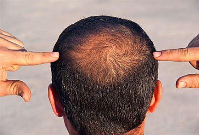 How Many Grafts Are Needed For A Crown Hair Transplant