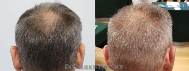 Back view before and after hair transplantation ,