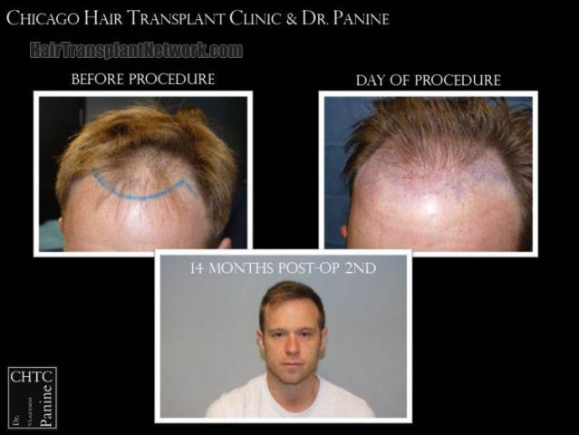 Front view - Before and after hair restoration procedure