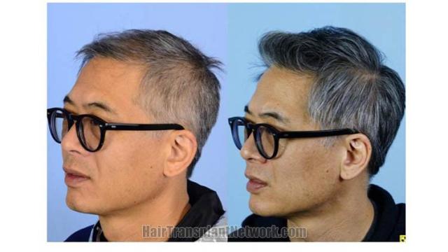 Hair restoration repair procedure before and after pictures