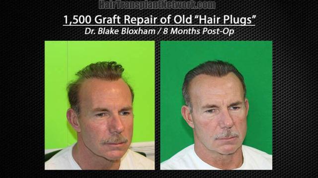 Hair restoration repair procedure before and after results