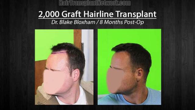 Hair transplantation repair surgery before and after photos