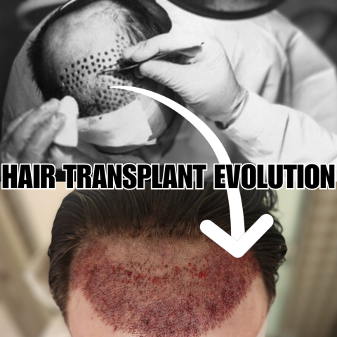 The History and Evolution of The Hair Transplant Industry