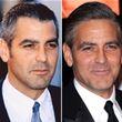 Did George Clooney Have A Hair Transplant?