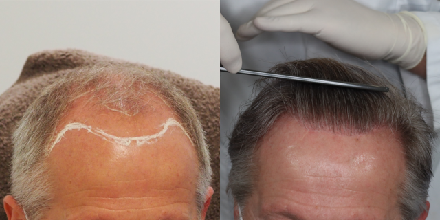Frontal before and after hair transplant