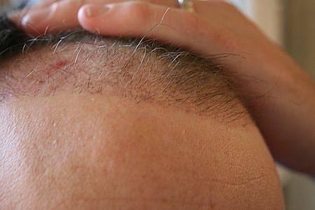 Hair transplant growth stages
