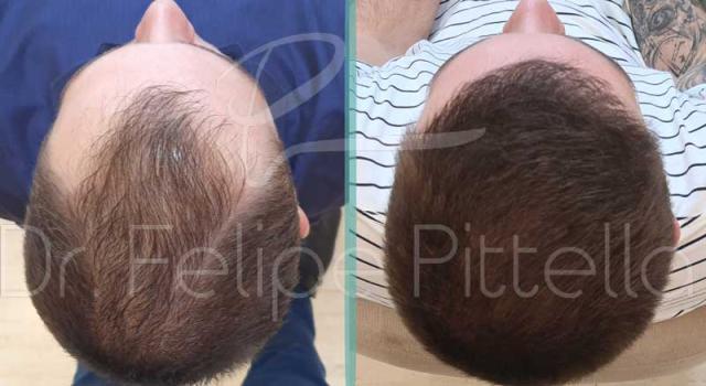 Overhead view before and after FUE hair transplant