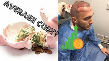 What Is The Average Cost of A Hair Transplant