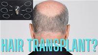 Can You Be Too Bald For A Hair Transplant?