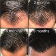 Hair Transplant Timeline