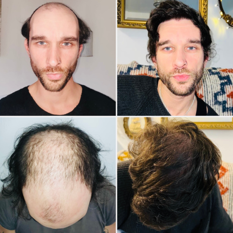 Should You Transplant the Hairline or Crown First?