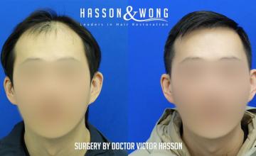 Hasson and Wong / Dr. Hasson / 4375 grafts / FUE / frontal zone/ some mid-scalp / 3 years post-op