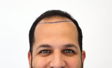 Dr Resul Yaman | 3880 Grafts 2 Years Result