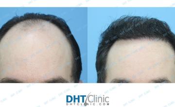 Dr. Damkerng Pathomvanich (DHT Clinic) / FUE 2,749 grafts 7 months post op