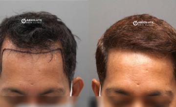 Dr. Kongkiat Laorwong, MD, FISHRS, 3300 grafts hairline and crown