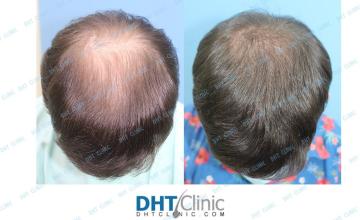 Dr. Damkerng Pathomvanich (DHT Clinic) / FUE 2,899 grafts 4 months post op with early hair growth