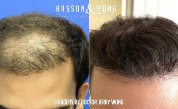 Dr. Wong / 5,783 Grafts / FUT Repair / 1 Session / 7.5 months post-op