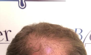 Ozlem Bicer MD-Hair Transplant-3560 Grafts FUE by micro-motor, 9. months result
