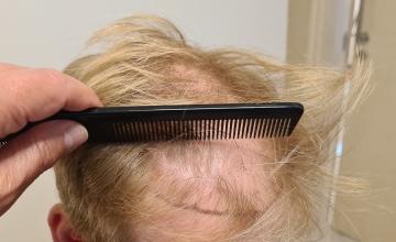 Mega session FUE Result for 4568 Grafts – HDC Hair Clinic – Dr Christina