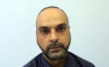 Dr Resul Yaman Hair Clinic - 4330 Grafts 9 Months Update