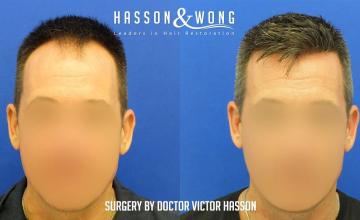 Dr. Hasson / 5031 grafts / FUE / 1 session / Hairline-Frontal Zone-Mid / dense pack / 10 months post-op