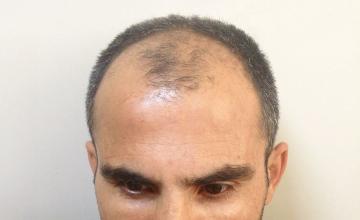 Dr Resul Yaman Hair Clinic - 4900 Grafts 8 Years Before - After Result