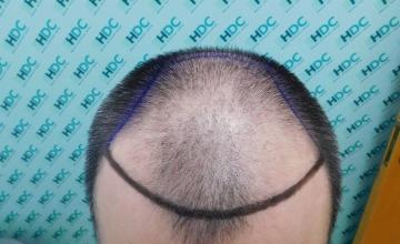 FUE Result for 4400 Grafts – 6 Months after – HDC Hair Clinic