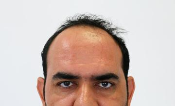 Dr Resul Yaman Hair Clinic - 4270 Grafts Result