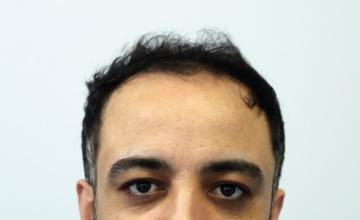 Dr Resul Yaman Hair Clinic - 3940 Grafts 7 Months Before - After Result