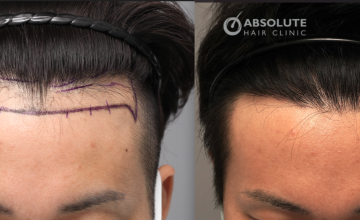 Dr. Kongkiat Laorwong, MD, FISHRS, male hairline  FUE 1920 grafts, 12 months post op