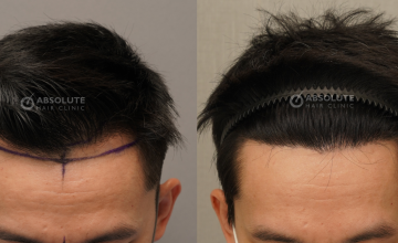 Dr. Kongkiat Laorwong, MD, FISHRS, male hairline  FUE 1845 grafts, 11 months post op