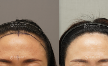 Dr. Kongkiat Laorwong, MD, FISHRS,  Female hairline,non shaven FUE 1500 grafts, 12 months post op
