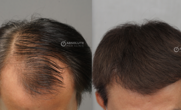 Dr. Kongkiat Laorwong, MD, FISHRS,  FUE 3200 grafts, 6 months post op