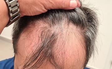 FUE Result Front 3655 Grafts – 0 to 6 months – HDC Hair Clinic – Dr Maras