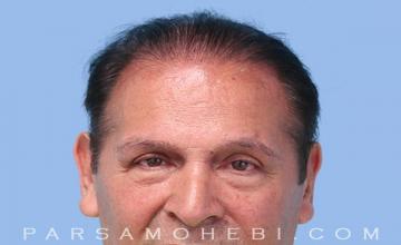 Eyebrow Hair Transplant by Dr. Parsa Mohebi