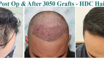 Before and 7.5 months After 3050 FUE grafts – Class 3 – Dr Christina – HDC Hair Clinic