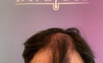 Ozlem Bicer MD-3500 Grafts FUE with psoriasis treatment